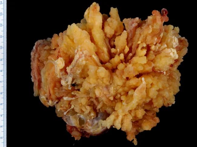 Imaging modality: Gross pathology photograph (macroscopic) of an excised ovarian mass. The specimen displays a cystic lesion with prominent serous papillary architecture. Macroscopic features include a tan-yellow to orange mass with numerous complex, variably sized papillary excrescences projecting from the cyst wall; surfaces are friable and irregular, with some translucent, lobulated fragments. The external contour is distorted by papillary fronds; a portion of ovarian stroma remains visible. Size context is provided by a ruler for scale, indicating a multi-centimeter greatest dimension. This appearance is typical for a serous borderline ovarian tumor (epithelial tumor of serous type) at gross examination, where papillary projections into the lumen are conspicuous but gross invasion is not evident. Histologic confirmation is required to assess borderline malignant potential, microinvasion, and implants. The gross pattern supports the diagnosis of SBOT, guiding surgical management, staging, and prognosis, and helps distinguish it from benign cystadenoma or malignant serous carcinoma on final pathology. Clinically, SBOTs occur in middle-aged to older women and generally have favorable outcomes after complete excision. Educational use includes gross-pathology references, radiologic correlation, differential diagnosis, and surgeon-pathologist communication. Documentation of the gross features complements histology and imaging, enabling accurate grading, prognosis, and multidisciplinary case discussion and planning.
