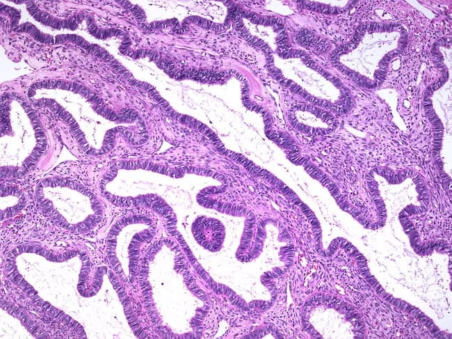 Imaging modality and technique: Light microscopy of formalin-fixed, paraffin-embedded ovarian tissue stained with Hematoxylin and Eosin (H&E). Primary subject: ovarian endometrioid cystadenoma, a benign epithelial neoplasm. Histology shows tubulocystic glands formed in back-to-back patterns and lined by cuboidal to columnar epithelium. The epithelium mimics normal endometrium, with glands exhibiting pseudostratified appearance but lacking cytologic atypia. Nuclei are uniform, with inconspicuous nucleoli and minimal pleomorphism; mitotic figures are rare. The stroma is typically fibrous with little desmoplasia; invasion of surrounding ovarian stroma is not evident. Some specimens may display squamous morules embedded within the epithelium, but without cytologic malignancy. Overall, the architecture favors a benign endometrioid phenotype rather than malignancy. Diagnostic significance: recognition of benign endometrioid lining helps distinguish endometrioid cystadenoma from ovarian endometrioid carcinoma, serous or mucinous cystadenomas with secondary endometrioid change, or mixed histology. Differential considerations include metastatic endometrium, mesonephric lesions, or other epithelial ovarian tumors. Clinical correlation includes patient age, imaging morphology of an adnexal mass, normal tumor markers, and definitive surgical pathology confirming benign behavior. Prognosis after complete excision is excellent; recommended follow-up per standard ovarian tumor protocols. Imaging-pathology concordance corroborates benign sequelae; avoid overtreatment; counsel patients on prognosis and routine gynecologic surveillance after surgical management completion.
