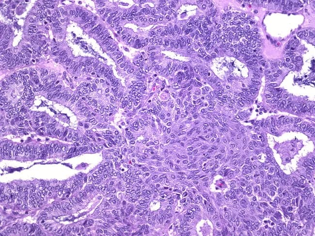 Imaging modality: Bright-field light microscopy of a hematoxylin and eosin stained ovarian tissue section. This histology shows an ovarian endometrioid carcinoma with focal squamous metaplasia (adenoacanthoma pattern). The architecture comprises back‑to‑back glandular structures and tubular glands lined by columnar to cuboidal epithelium with mild to moderate nuclear atypia and evident mitotic activity. In adjacent foci, nests and sheets of squamous cells display intercellular bridges and distinct squamous differentiation within the tumor, consistent with squamous metaplasia. The overall tumor demonstrates typical endometrioid morphology interlaced with solid and cribriform areas, within a fibromuscular ovarian stroma. The combination of glands with squamous differentiation characterizes the adenoacanthoma variant of ovarian endometrioid carcinoma; this feature has been reported in up to 50% of such tumors. Clinically, recognition of squamous metaplasia matters for accurate histologic grading, differential diagnosis against serous, mucinous, or teratomatous processes, and may influence prognosis and treatment planning. Immunohistochemical panels (e.g., CK7, PAX8, ER, PR) may corroborate endometrioid differentiation. This image is valuable for education, pathology practice, and research on divergent differentiation in ovarian epithelial neoplasms and the biological significance of squamous metaplasia within endometrioid carcinomas. This snapshot supports educational annotation, correlates histology with molecular profiling, and informs patient-specific management decisions in practice.