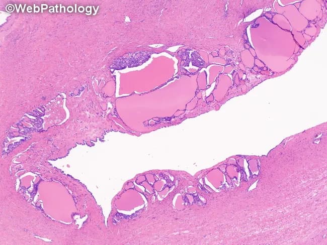 Struma ovarii is a monodermal variant of ovarian teratoma composed predominantly or exclusively of mature thyroid tissue. The micrograph shows thyroid follicles within the cyst wall in a case of struma ovarii. Follicles vary in size and architectural pattern, ranging from normal-like to hyperplastic or adenomatous. The follicular lining is cuboidal to flattened and may exhibit clear or oxyphilic cytoplasm. Nuclei are uniform, hyperchromatic, and basally located, with little to no mitotic activity. Follicles are filled with eosinophilic colloid; occasional birefringent calcium oxalate crystals may be present within colloid material. Parafollicular C cells are not identified in this specimen. The stromal compartment surrounding the follicles is typically scant and collagenous, but in some cases it can be more abundant and edematous; rare instances show stromal luteinization. The combination of thyroid-type follicles within an ovarian cyst wall confirms the diagnosis of struma ovarii. Clinically, these lesions are usually benign, though malignant transformation has been described and occasional thyrotoxicosis may occur with functional ovarian tissue. Histology is essential to differentiate struma ovarii from metastatic thyroid tissue, toxic goiter involving the ovary, or other teratomatous components. Immunohistochemical staining for thyroglobulin and TTF-1 can corroborate thyroid origin. This educational image aids diagnostic correlation greatly.