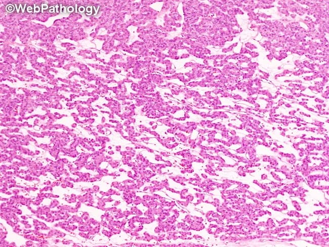 Imaging modality: Bright-field light microscopy of hematoxylin and eosin (H&E) stained tissue from an ovarian teratoma composed of ectopic thyroid tissue (struma ovarii). Precise anatomical context: pelvic ovary; thyroid-like follicular epithelium organizing into trabecular cords and small follicular clusters with colloid-filled lumina, reminiscent of native thyroid architecture. The current micrograph demonstrates thyroid follicles arranged in a trabecular pattern within the stromal background of ovarian tissue. Follicular cells are cuboidal to low-columnar with uniform nuclei and scant cytoplasm; colloid within follicles stains eosinophilic and appears pale pink on H&E. The overall morphology is benign-appearing; no overt cellular atypia, mitotic activity, or stromal invasion is evident in this field. In struma ovarii, this ectopic thyroid tissue mirrors normal thyroid histology, and is a diagnostic clue when evaluating ovarian teratomas. Key differential considerations include other patterns of struma ovarii (solid sheets, pseudopapillary, pseudotubular, or cystic) and rare malignant transformation such as papillary thyroid carcinoma arising in struma ovarii; clinical correlation with thyroid function and imaging is advised. This description supports diagnosis of ectopic thyroid tissue within an ovarian lesion and assists in distinguishing struma ovarii from metastatic thyroid carcinoma to the ovary. Potential clinical use: surgical planning, risk assessment, and subtler differential diagnosis in ovarian mass workup.