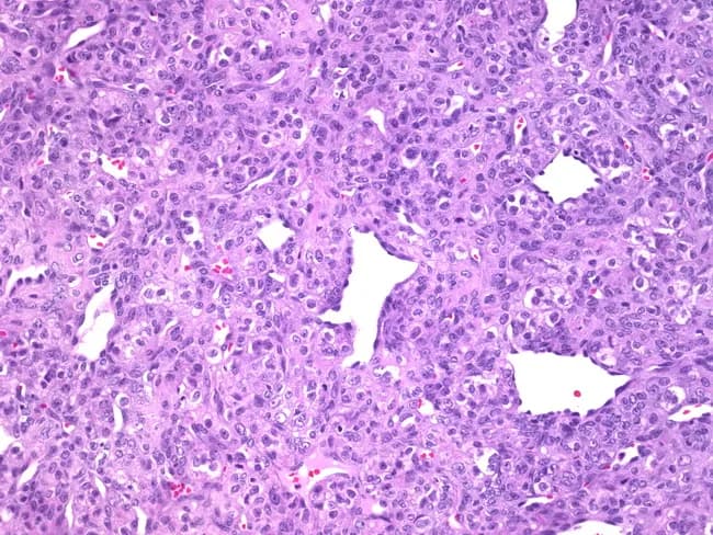 This image is a bright-field histology slide of liver parenchyma prepared by routine hematoxylin and eosin (H&E) staining and examined under light microscopy at high magnification. The specimen represents a biopsy tissue section oriented through hepatic lobules, showing cords of hepatocytes arranged in plate-like rows separated by narrow sinusoidal spaces. Hepatocytes are predominantly polygonal with round to oval nuclei and moderately basophilic cytoplasm; occasional binucleated cells are visible, consistent with normal hepatic turnover. The nuclear chromatin is evenly dispersed with visible nucleoli in a subset of hepatocytes. Intervening sinusoids appear as slender, pale vascular channels containing sparse red blood cells; there is no overt cholestasis. The overall architecture appears preserved without obvious disarray of cords, portal tract expansion, or focal necrosis in this field. No conspicuous inflammatory infiltrate or fibrotic bands are evident within the captured region. In this limited field, there is no clear evidence of steatosis, steatohepatitis, or malignant transformation, although small sampling areas may not reflect the entire organ. This image can serve as a reference for normal hepatic histology, educational demonstrations of hepatocyte morphology, and comparison with pathologic liver specimens. It has utility in training, research datasets, and radiology-pathology correlation exercises for hepatology and gastroenterology education.