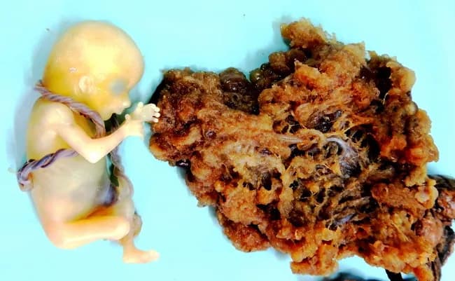 Gross pathology photograph of gestational tissue from a 30-year-old woman at approximately 14 weeks gestation. The image demonstrates placental tissue with admixture of vesicular hydropic villi and areas of normal villous architecture, accompanied by focal blood clots. A live fetus with intact umbilical cord is present adjacent to the placental tissue, consistent with partial hydatidiform mole in which a triploid conceptus coexists with molar villi. The case description notes paternal duplication or dispermic fertilization as the cytogenetic basis for triploidy (commonly 69,XXY) and highlights distinguishing features of partial mole. Incomplete moles can progress to invasion in less than 5% of cases, whereas complete hydatidiform moles show higher risk of persistent trophoblastic disease and choriocarcinoma. The gross morphology in this specimen--mixed vesicular and solid villous components with hemorrhagic clots--reflects hydropic change and trophoblastic proliferation occurring within placental tissue. Clinically, the presentation includes amenorrhea, vaginal bleeding, and uterine enlargement; ultrasound may reveal abnormal placentation with an intrauterine fetus. Differential considerations include complete mole, choriocarcinoma, invasive mole, and other GTD entities. Management typically involves termination with subsequent surveillance for persistent gestational trophoblastic disease. Ancillary notes emphasize molecular cytogenetics for definitive classification when available.