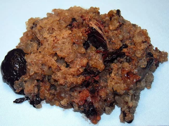 Gross pathology photograph of placental tissue containing hydropic vesicles consistent with a complete hydatidiform mole. This macroscopic specimen shows numerous variably sized, grape-like vesicular masses that replace normal placental architecture and lack detectable embryonic tissue. The vesicles are translucent to tan-brown, with sparse intervening hemorrhagic debris and dark, friable tissue components representing decidualized maternal tissue. The gross appearance corresponds to the pathognomonic feature of complete mole, which is characterized by diffuse trophoblastic proliferation and hydropic chorionic villi due to abnormal paternal genomic imprinting. Clinically, complete moles typically present with markedly elevated human chorionic gonadotropin (hCG), vaginal bleeding, and uterine enlargement disproportionate to gestational age; ultrasound in the modern era often reveals a heterogeneous, multicystic intrauterine mass. Histology (not shown in this image) would demonstrate diffuse villous edema with circumferential trophoblastic proliferation and absence of fetal tissue. The specimen’s appearance aids diagnosis, informs management (uterine evacuation and serial hCG monitoring), and raises consideration for persistent gestational trophoblastic disease. In differential terms, this contrasts with partial mole (embryo/fetus present with focal villous swelling) and with nonmolar miscarriage. This image is valuable for education, pathology training, and radiologic-pathologic correlation in obstetric medicine. This educational image supports recognition of mole pathology in clinical practice.