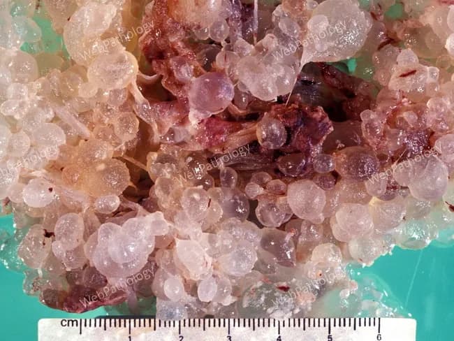 Gross pathology photograph of gestational tissue demonstrating complete hydatidiform mole. The specimen shows numerous swollen, vesicular, grape-like villous clusters with translucent to pale purple laminae and irregular surface architecture. No fetus or embryonic tissue is visible in the sample. A centimeter ruler is present for scale, confirming macroscopic vesicle diameters ranging from approximately 2-8 mm and overall tissue mass consistent with hydropic degeneration. The villous structures are edematous with cistern formation, and the tissue appears friable and bulky, representing diffuse trophoblastic involvement. The gross pattern is classic for a complete mole, characterized by diffuse villous edema, circumferential hydropic change, and lack of fetal tissue; the lesion may be accompanied by hemorrhagic foci and necrosis in larger specimens. This image is diagnostic when integrated with clinical data: markedly elevated beta-hCG, uterus enlargement, and ultrasound findings of a hollow, cystic placental mass. Diagnostic significance lies in identifying gestational trophoblastic disease early to guide uterine evacuation and obstetric management, while recognizing risk for persistent GTD and potential progression to choriocarcinoma. Potential clinical use cases include education on molar pregnancy morphology, gross pathology correlation with histology, and training for pathology residents in gross specimen handling and reporting.