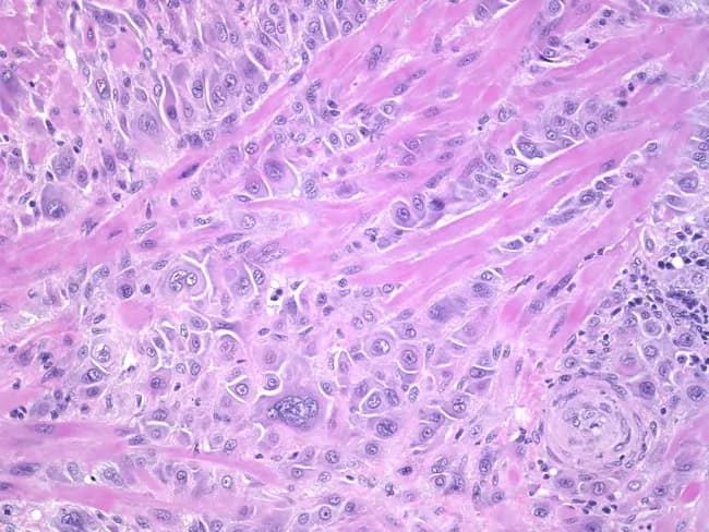 Light microscopy of hematoxylin and eosin–stained uterine tissue demonstrates invasive trophoblastic proliferation. The primary neoplastic element comprises intermediate trophoblastic cells with pleomorphic, enlarged nuclei and conspicuous nucleoli, dispersed in coherent sheets and singly scattered within the deep myometrium at the placental bed. Multinucleated giant cells are present, along with occasional clusters of cells showing subtle cytoplasmic eosinophilia. The tumor demonstrates deep myometrial invasion with irregular nests extending well away from the endometrial–myometrial junction, with minimal accompanying stromal desmoplasia. Cellular morphology includes moderate cytoplasm, nuclear variability, and occasional mitotic figures, though mitotic activity is not prominent. The architectural pattern lacks diffuse cytotrophoblastic and abundant syncytial proliferation seen in choriocarcinoma, and there is relative preservation of placental barrier features in otherwise infiltrative tissue. These findings are most compatible with an invasive trophoblastic neoplasm arising from placental site trophoblastic tumor (PSTT) or epithelioid trophoblastic tumor (ETT) spectrum, rather than classic choriocarcinoma. Clinically, such histology correlates with gestational trophoblastic disease and necessitates correlation with serum hCG, pregnancy history, and imaging. Differential diagnoses include PSTT, ETT, choriocarcinoma, and invasive mole; the prognosis and treatment vary, with PSTT/ETT often requiring surgical management and close follow-up with surveillance.
