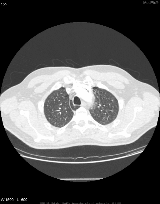 **Imaging Modality:** Computed Tomography (CT) of the chest, axial section, displayed in lung window settings.
**Anatomical Region:** Upper thorax at the level of the aortic arch and tracheal bifurcation.
**Observed Pathology/Anatomical Variant:** An **azygos lobe** is identified in the apex of the right lung.
**Characteristic Visual Features:**
- **Azygos Fissure:** A distinct, curvilinear thin line (pleural reflection) is visible traversing the right upper lung field. This fissure is composed of four layers of pleura (two visceral and two parietal).
- **Azygos Vein:** At the inferior aspect of the fissure, a focal, teardrop-shaped density is noted, representing the abnormally positioned azygos vein.
- **Lung Parenchyma:** The portion of the right lung located medial to the fissure constitutes the accessory azygos lobe. The surrounding lung parenchyma appears otherwise clear without evidence of consolidation or masses.
**Key Diagnostic Features:** The pathognomonic finding of a high-riding azygos vein within a displaced pleural fissure, creating an accessory lobe in the right lung apex. This is a common incidental anatomical variant resulting from the failure of the azygos vein to migrate medially over the lung apex during development.