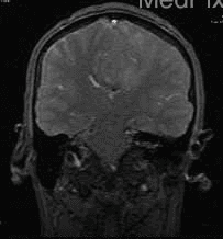 **Imaging Modality:** Magnetic Resonance Imaging (MRI), Coronal plane.