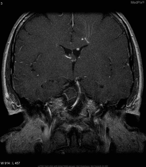 **Imaging Modality:** Magnetic Resonance Imaging (MRI), Coronal view.
**Anatomical Region:** Brainstem and posterior fossa, specifically the prepontine cistern and the cerebellopontine angle (CPA).
**Observed Pathology:** The image demonstrates a neurovascular contact or conflict involving the right trigeminal nerve (CN V). A prominent, tortuous vascular structure, likely the superior cerebellar artery (SCA) or an elongated basilar artery, is seen in close proximity to the right trigeminal nerve root entry zone.
**Characteristic Visual Features:**
- **Vascular contact:** A hypointense flow void or enhancing vessel is positioned immediately adjacent to the cisternal segment of the right trigeminal nerve.
- **Asymmetry:** Compared to the contralateral (left) side, the right prepontine cistern shows crowding due to the vascular loop.
- **Landmarks:** Visible structures include the pons, third ventricle, and the petrous temporal bone.
**Clinical Context:** These radiologic findings are highly suggestive of trigeminal neuralgia (tic douloureux) caused by vascular compression of the nerve.
**Diagnostic Features:** The key differentiating feature is the direct contact between a vascular loop and the trigeminal nerve at its point of exit from the pons, a common etiology for facial pain syndromes.