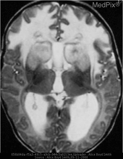 **Imaging Modality:** Magnetic Resonance Imaging (MRI), Axial T2-weighted sequence.