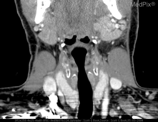 **Imaging Modality:** Contrast-enhanced Computed Tomography (CT), Coronal reformatted view.
**Anatomical Region:** Head and neck, specifically focusing on the salivary glands and suprahyoid/infrahyoid neck spaces.
**Observed Pathology:** The image demonstrates bilateral enlargement of the parotid glands, consistent with sialadenitis. The glands appear hyperdense and mildly heterogeneous compared to typical fatty parotid parenchyma. There is associated soft tissue swelling in the submandibular and cervical regions.
**Characteristic Visual Features:**
- **Bilateral Parotid Gland Involvement:** Symmetric enlargement and increased enhancement of the parotid glands.
- **Differentiating Features:** The absence of discrete, rim-enhancing fluid collections suggests diffuse inflammatory change (sialadenitis) rather than a mature abscess.
- **Secondary Findings:** Mild inflammatory stranding is visible in the overlying subcutaneous fat. The airway remains patent and midline.
**Clinical Context:** Findings are highly suggestive of acute infectious sialadenitis, frequently caused by viral pathogens (such as mumps/myxovirus) or bilateral bacterial infection. The imaging helps differentiate diffuse inflammation from obstructive sialolithiasis or localized neoplastic processes.