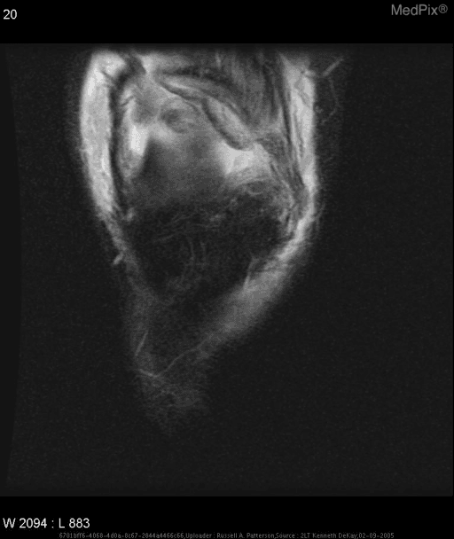 **Imaging Modality:** Magnetic Resonance Imaging (MRI), T2-weighted or STIR sequence.
**Anatomical Region:** Anterior knee, axial or coronal cross-section of the extensor mechanism.
**Observed Pathology:** Evidence of a high-grade or complete quadriceps tendon rupture. There is a significant disruption of the normal low-signal tendinous fibers proximal to the superior pole of the patella.
**Characteristic Visual Features:**
- **Signal Abnormality:** Presence of extensive high-signal intensity (edema/hemorrhage) occupying the expected location of the quadriceps tendon.
- **Tendon Morphology:** Loss of continuity and wavy, retracted appearance of the remaining tendon fibers.
- **Associated Findings:** Evidence of a medial retinacular tear, indicated by signal hyperintensity and fiber discontinuity along the medial aspect of the patellofemoral joint. Significant soft tissue swelling and joint effusion are visible surrounding the injury site.
**Differentiating Features:** The total disruption of the trilaminar appearance of the quadriceps tendon and the associated retraction distinguish this from simple tendinosis or partial-thickness tears. The localization proximal to the patella differentiates it from patellar tendon rupture.