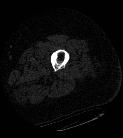 **Imaging Modality:** Axial Computed Tomography (CT) scan.
**Anatomical Region:** Mid-shaft of a long bone (likely the femur or humerus) and surrounding soft tissues of the extremity.
**Observed Pathology:** Chronic osteomyelitis with characteristic features of bone remodeling and sequestration.
**Characteristic Visual Features:**
* **Sequestrum:** A central, hyperdense fragment of necrotic bone is visible within the medullary cavity, detached from the surrounding living bone.
* **Involucrum:** Marked circumferential cortical thickening and reactive sclerosis are present, representing the formation of new bone sheath around the infected site.
* **Cortical Irregularity:** There is evidence of cortical erosion and architectural distortion.
* **Soft Tissue Involvement:** Diffuse swelling and blurring of myofascial planes are noted in the adjacent soft tissues, suggesting associated inflammation or phlegmon.
**Key Diagnostic Features:** The combination of a dense, sequestered bone fragment (sequestrum) surrounded by thickened reactive bone (involucrum) is pathognomonic for chronic osteomyelitis. This CT image effectively demonstrates the classic radiographic "bone within a bone" appearance used to differentiate chronic infectious processes from acute osteomyelitis or primary bone tumors.