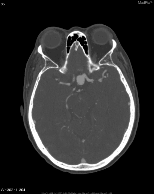 **Imaging Modality:** Computed Tomography Angiography (CTA), axial section.