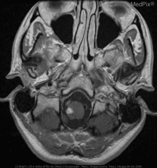 **Imaging Modality:** Magnetic Resonance Imaging (MRI), axial T2-weighted section.
**Anatomical Region:** Axial section at the level of the craniocervical junction, specifically focusing on the medulla oblongata and posterior fossa.
**Observed Pathology:** There is a focal, well-defined area of hyperintensity located in the right dorsolateral aspect of the medulla oblongata. The lesion is consistent with an acute or subacute ischemic infarct in the territory of the posterior inferior cerebellar artery (PICA) or the vertebral artery.
**Characteristic Visual Features:**
* **Signal Intensity:** High T2 signal (hyperintense) relative to the surrounding brainstem parenchyma.
* **Localization:** Precise involvement of the lateral medullary segment, characteristic of Lateral Medullary Syndrome (Wallenberg Syndrome).
* **Mass Effect:** Minimal to no significant mass effect or displacement of the fourth ventricle/medulla midline is observed in this section.
* **Surrounding Structures:** The cerebellum and surrounding cisterns appear unremarkable at this level.
**Key Diagnostic Features:** The specific dorsolateral medullary localization of the hyperintense signal is the hallmark radiologic finding for PICA territory infarction, correlating clinically with Wallenberg Syndrome.