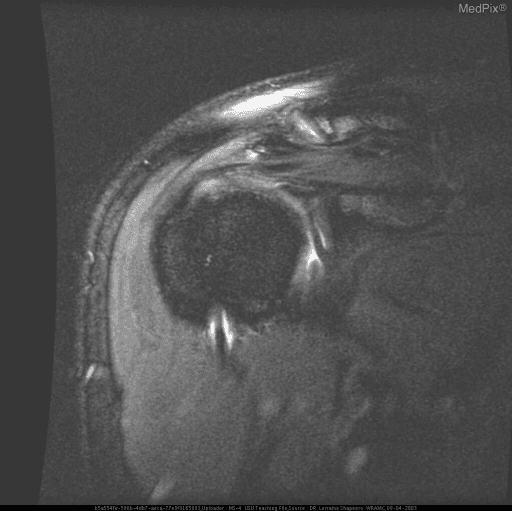 **Imaging Modality:** Magnetic Resonance Imaging (MRI), coronal oblique view, fat-saturated T2-weighted or proton density sequence.
**Anatomical Region:** Right shoulder glenohumeral joint.
**Observed Pathology:** Post-traumatic changes consistent with a prior anterior glenohumeral dislocation. The image demonstrates a Hill-Sachs lesion, characterized by a cortical depression and marrow signal abnormality (bone bruise) on the posterolateral aspect of the superior humeral head.
**Characteristic Visual Features:**
* **Hill-Sachs Deformity:** A distinct contour defect and focal hyperintensity in the subchondral bone of the posterolateral humeral head, indicating an impaction fracture.
* **Labral Assessment:** There is evidence of a Bankart lesion, visualized as a disruption of the anteroinferior glenoid labrum with associated high signal intensity, suggesting a tear.
* **Joint Space:** Mild joint effusion is present. The acromioclavicular joint and subacromial space are visible superiorly.
**Clinical Significance:** These findings are pathognomonic for anterior instability of the shoulder. The combination of a Hill-Sachs impaction fracture and a Bankart labral tear is a common sequela of shoulder dislocation, increasing the risk of chronic recurrent instability and secondary osteoarthritis.