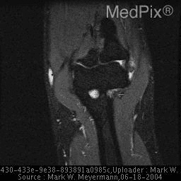 **Imaging Modality:** Magnetic Resonance Imaging (MRI), Coronal view.
**Anatomical Region:** Elbow joint, specifically focusing on the humeroradial and humeroulnar articulations and surrounding soft tissues.
**Observed Pathology:** The image demonstrates features consistent with **lateral epicondylitis** (tennis elbow). There is an increased signal intensity and thickening at the origin of the **common extensor tendon** near the lateral epicondyle of the humerus.
**Characteristic Visual Features:**
- **Signal Abnormality:** Hyperintense signal on T2-weighted/STIR-weighted imaging at the lateral aspect of the elbow, indicating edema or microtearing within the common extensor origin (primarily the extensor carpi radialis brevis).
- **Landmarks:** Distinct visualization of the lateral and medial epicondyles, the radial head, and the capitellum.
- **Secondary Findings:** Mild joint effusion may be present. The medial collateral ligament and medial epicondyle appear relatively unremarkable in this slice.
**Key Diagnostic Features:** Focal signal alteration at the lateral epicondyle is the primary radiographic cue for tendinosis or tendinopathy of the wrist extensors, differentiating it from medial epicondylitis or intra-articular loose bodies.