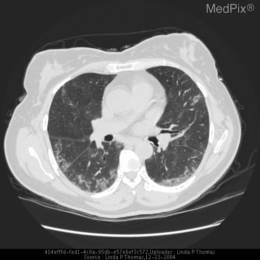 **Imaging Modality:** High-resolution computed tomography (HRCT) of the chest, axial section.
