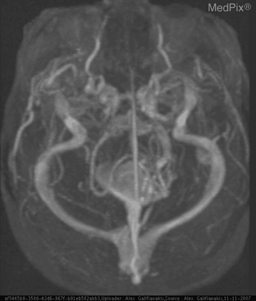 **Imaging Modality:** Magnetic Resonance Venography (MRV), Maximum Intensity Projection (MIP) reconstruction.