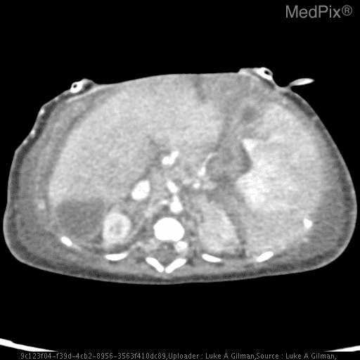 **Imaging Modality:** Axial contrast-enhanced Computed Tomography (CT) scan of the upper abdomen.