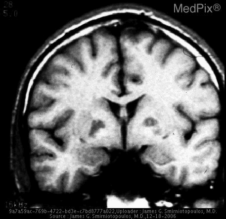 **Imaging Modality:** Magnetic Resonance Imaging (MRI), T1-weighted sequence.
**Anatomical Region:** Coronal section of the brain at the level of the basal ganglia and lateral ventricles.
**Observed Pathology:** Carbon monoxide (CO) poisoning.
**Characteristic Visual Features:** The image demonstrates bilateral, relatively symmetric areas of signal abnormality localized to the globus pallidus. These lesions appear as well-defined, focal regions of hypointensity on this T1-weighted sequence. The surrounding white matter and cortical structures appear grossly preserved, though there is a subtle suggestion of generalized cerebral volume loss.
**Clinical Context:** Bilateral necrosis or signal alteration of the globus pallidus is a hallmark radiologic finding of acute or subacute carbon monoxide toxicity, resulting from the high metabolic demand of these nuclei and the carboxyhemoglobin-induced hypoxic-ischemic insult.
**Key Diagnostic Features:** Symmetric involvement of the globus pallidus is a classic "signature" finding that helps differentiate CO poisoning from other causes of basal ganglia lesions, such as Wilson's disease, cyanide poisoning, or Leigh syndrome.