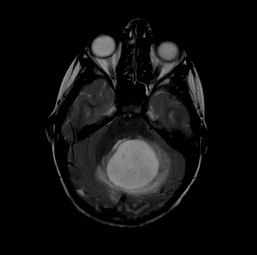 **Imaging Modality:** Magnetic Resonance Imaging (MRI), Axial view, T2-weighted/FLAIR sequence.