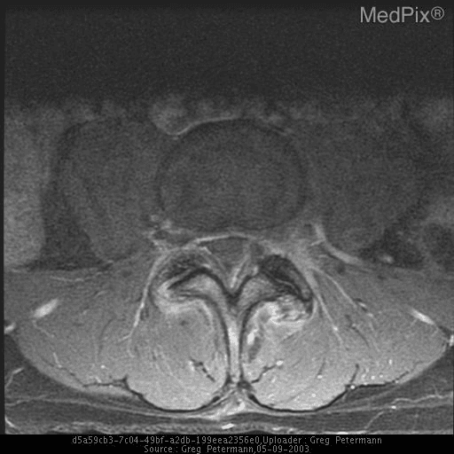 **Imaging Modality:** Axial Magnetic Resonance Imaging (MRI), T1-weighted sequence with contrast enhancement.
**Anatomical Region:** Lumbar spine at the level of the facet joints.
**Observed Pathology:** Bilateral lumbar synovial cysts originating from the zygapophyseal (facet) joints.
**Characteristic Visual Features:**
The image demonstrates bilateral, well-circumscribed cystic lesions located adjacent to the facet joints, extending into the spinal canal. The cysts exhibit a characteristic peripheral rim enhancement following contrast administration, indicating an inflammatory or vascularized capsule. There is associated facet joint hypertrophy and degenerative changes. The cysts exert mass effect on the thecal sac, resulting in narrowing of the central spinal canal (spinal stenosis).
**Key Diagnostic Features:**
- **Location:** Juxtafacet position, communicating with the joint capsule.
- **Morphology:** Extradural cystic masses with rim enhancement.
- **Impact:** Significant ventrolateral compression of the thecal sac and potential impingement of traversing nerve roots.
**Clinical Significance:** These findings are characteristic of symptomatic degenerative spondylosis, frequently leading to radiculopathy or neurogenic claudication. This image is a primary reference for diagnosing spinal synovial cysts and assessing the degree of secondary canal stenosis.