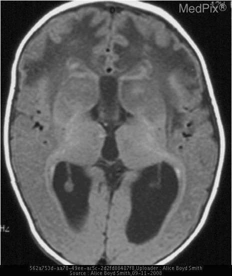 **Imaging Modality:** Axial Magnetic Resonance Imaging (MRI), T1-weighted sequence.