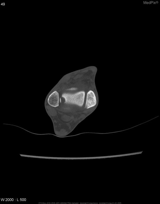 **Imaging Modality:** Computed Tomography (CT), bone window settings.