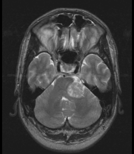 **Imaging Modality:** Magnetic Resonance Imaging (MRI), Axial T2-weighted sequence.
**Anatomical Region:** Posterior cranial fossa at the level of the cerebellopontine angle (CPA).
**Observed Pathology:** A large, well-circumscribed, heterogeneous hyperintense mass is situated in the left cerebellopontine angle. This finding is highly characteristic of a Vestibular Schwannoma (Acoustic Neuroma).
**Characteristic Visual Features:**
* **Location:** The lesion originates within the left CPA and extends medially.
* **Mass Effect:** Significant compression and rightward displacement of the brainstem (pons) and the fourth ventricle. There is associated effacement of the surrounding cisterns.
* **Signal Intensity:** Heterogeneous high T2 signal, suggesting solid components with potential areas of cystic degeneration or proteinaceous fluid.
* **Morphology:** The "ice cream cone" appearance is suggested where the mass occupies the CPA cistern and extends toward the internal auditory canal.
**Key Diagnostic Features:** The presence of a localized CPA mass causing mass effect on the brainstem in the context of vestibular schwannoma pathology. Differential diagnoses for this location typically include meningioma or epidermoid cyst, though the T2 signal and morphology here strongly favor schwannoma.