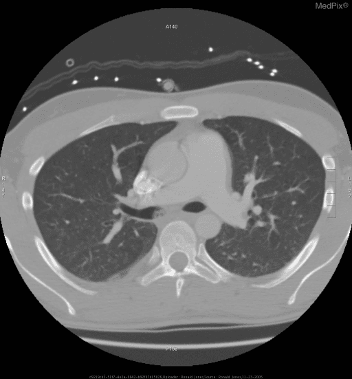 **Imaging Modality:** Axial Computed Tomography (CT) scan of the chest.
**Anatomical Region:** Thorax at the level of the pulmonary artery bifurcation and carina.
**Observed Pathology:** The lungs exhibit diffuse, bilateral hyperlucency and a paucity of peripheral vascular markings, characteristic of pulmonary emphysema. There is evidence of bronchial wall thickening, suggesting chronic bronchitis, consistent with Chronic Obstructive Pulmonary Disease (COPD).
**Characteristic Visual Features:**
- **Lung Parenchyma:** Increased radiolucency with attenuation of the pulmonary vasculature.
- **Mediastinum:** Prominent main pulmonary artery trunk, which may indicate pulmonary hypertension secondary to chronic lung disease. A dense, calcified focus is noted within the right hilar region, likely representing a calcified lymph node or vascular calcification.
- **Thoracic Cage:** Mild increase in the anteroposterior diameter of the chest.
- **Pleura:** A small, dependent pleural effusion or pleural thickening is visible in the posterior right hemithorax.
**Diagnostic Context:** These radiologic findings are highly suggestive of chronic obstructive airway disease with significant emphysematous changes and associated airway inflammation.