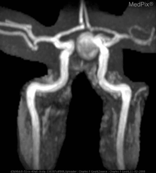 **Imaging Modality:** Time-of-Flight (TOF) Magnetic Resonance Angiography (MRA), Maximum Intensity Projection (MIP) reconstruction.