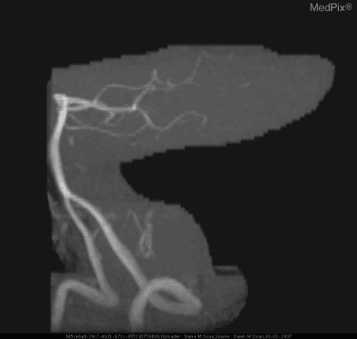 **Imaging Modality:** Magnetic Resonance Angiography (MRA), Maximum Intensity Projection (MIP) reconstruction.
**Anatomical Region:** Posterior cranial fossa vasculature, specifically the vertebrobasilar system.
**Observed Pathology:** Lateral medullary infarction (Wallenberg Syndrome) context. The image demonstrates the arterial anatomy of the posterior circulation. There is a notable absence or significant attenuation of the distal segments of the posterior inferior cerebellar artery (PICA) on the affected side compared to expected vascular distribution. The vertebral artery and basilar artery are visualized, but the lateral branching patterns relevant to the lateral medulla appear compromised.
**Characteristic Visual Features:**
- High-signal vascular reconstruction against a suppressed background.
- Visualization of the bilateral vertebral arteries merging into the basilar artery.
- Evaluation of the PICA origin and course; vascular dropout in the distribution of the lateral medulla and inferior cerebellum is the primary diagnostic cue.
**Clinical Context:** This neuroimaging is used to identify vascular occlusion or dissection in patients presenting with acute lateral medullary syndrome, characterized clinically by ipsilateral ataxia, Horner's syndrome, and contralateral loss of pain/temperature sensation.
**Key Diagnostic Features:** Focal vascular truncation or absence of the PICA, correlating with acute ischemic territory in the lateral medulla.
