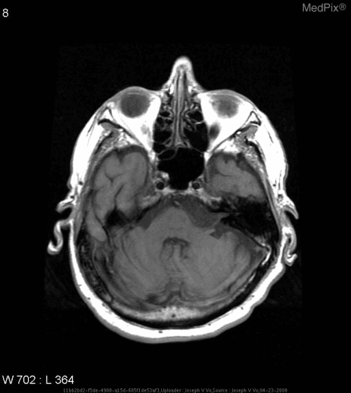 **Imaging Modality:** Magnetic Resonance Imaging (MRI), T1-weighted axial sequence.
**Anatomical Region:** Posterior cranial fossa at the level of the cerebellopontine angle (CPA) and pons.
**Observed Pathology:** There is an irregular, lobulated, extra-axial mass located within the left cerebellopontine angle cistern. The lesion appears hypointense relative to the brain parenchyma, roughly isointense to cerebrospinal fluid (CSF) on this T1-weighted image.
**Characteristic Visual Features:** The mass demonstrates a "creeping" or "encapsulating" growth pattern, filling the subarachnoid space and mildly displacing the adjacent pons and cerebellum without significant parenchymal edema. It extends into the ambient cistern and follows the contours of the brainstem. The margins are well-defined but scalloped. There is no evidence of gross midline shift or obstructive hydrocephalus at this level.
**Key Diagnostic Features:** The CSF-like signal intensity and the tendency to envelop rather than displace local neurovascular structures are classic radiologic features suggestive of an intracranial epidermoid cyst. Differential considerations for CPA masses include arachnoid cyst, vestibular schwannoma, and meningioma.