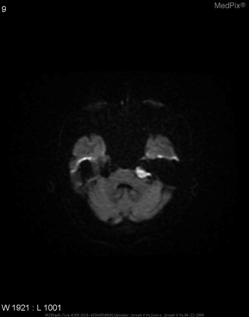 **Imaging Modality:** Diffusion-Weighted Imaging (DWI) Magnetic Resonance Imaging (MRI).
**Anatomical Region:** Axial section of the brain at the level of the posterior fossa and skull base, specifically involving the left cerebellopontine angle (CPA) cistern.
**Observed Pathology:** There is a well-circumscribed, focal area of marked hyperintensity (restricted diffusion) located in the left cerebellopontine angle. The lesion appears to exert mild mass effect on the adjacent brainstem and cerebellum.
**Characteristic Visual Features:** The lesion demonstrates high signal intensity on this DWI sequence, which is a hallmark finding for an intracranial epidermoid cyst. The morphology is somewhat lobulated, consistent with the characteristic "creeping" growth pattern of epidermoids that fill and expand subarachnoid cisterns.
**Key Diagnostic Features:** The intense hyperintensity on DWI is the primary differentiating feature used to distinguish an epidermoid tumor from an arachnoid cyst (which typically follows CSF signal and shows no diffusion restriction). This finding, combined with the anatomical location in the CPA cistern, is highly suggestive of an intracranial epidermoid tumor.