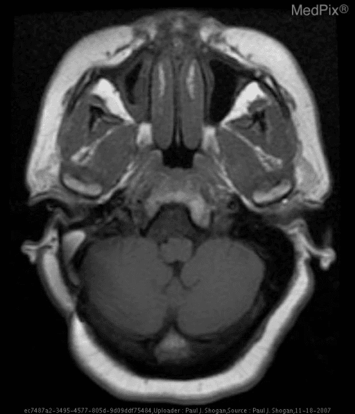 **Imaging Modality:** Magnetic Resonance Imaging (MRI), T1-weighted sequence.