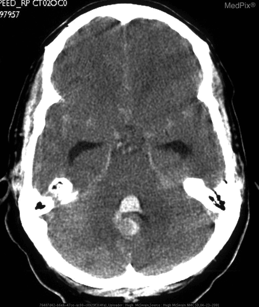 **Imaging Modality:** Non-contrast axial Computed Tomography (CT) of the head.