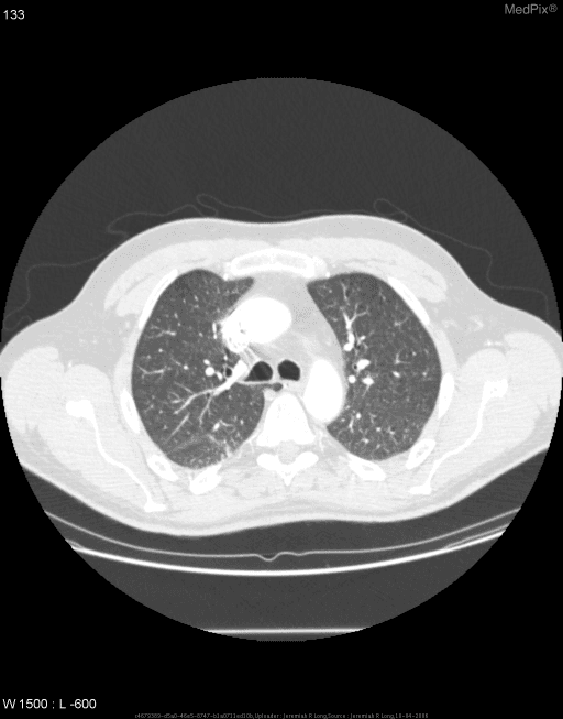 **Imaging Modality:** Computed Tomography (CT) of the chest, axial section, lung window.
**Anatomical Region:** Upper thorax at the level of the great vessels and tracheal bifurcation.
**Observed Pathology/Anatomic Variant:** Azygos fissure and azygos lobe of the right lung.
**Characteristic Visual Features:**
* **Azygos Fissure:** A fine, curvilinear high-attenuation line is visible traversing the right upper lung zone. This represents the invaginated mesoazygos, consisting of four layers of pleura (two visceral and two parietal).
* **Azygos Vein:** At the medial/anterior termination of the fissure, a small, rounded soft tissue density is noted, representing the azygos vein in an anomalous cephalad position.
* **Azygos Lobe:** The accessory fissure separates the superior-medial portion of the right upper lobe, creating an accessory "azygos lobe."
**Key Diagnostic Features:** The pathognomonic "teardrop" appearance of the azygos vein at the end of the curvilinear fissure in the right apex. The underlying lung parenchyma within the accessory lobe demonstrates normal attenuation and vascularity.
**Clinical Context:** This is a common incidental anatomical variant resulting from the failure of the azygos vein to migrate medially over the lung apex during embryogenesis.