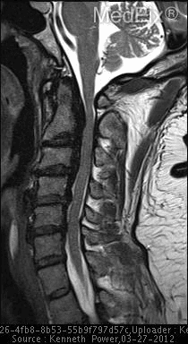 **Imaging Modality:** Sagittal T2-weighted Magnetic Resonance Imaging (MRI) of the cervical spine.