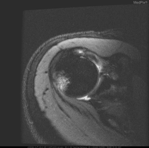 **Imaging Modality:** Magnetic Resonance Imaging (MRI), axial plane.
**Anatomical Region:** Shoulder joint (glenohumeral joint).
**Observed Pathology:**
* **Hill-Sachs Lesion:** A prominent impaction fracture is visible on the posterolateral aspect of the humeral head. This is characterized by a cortical depression and subchondral marrow edema, appearing as an area of increased signal intensity on this fluid-sensitive sequence.
* **Bankart Lesion:** Evidence of injury to the anteroinferior glenoid labrum. There is disruption of the labral-ligamentous complex, consistent with an avulsion of the labrum from the glenoid rim.
* **Joint Effusion:** Increased intra-articular signal intensity indicates presence of joint fluid/effusion.
**Characteristic Visual Features:** The "hatchet" deformity of the posterior humerus and the blunting/detachment of the anterior labrum are classic markers of shoulder instability.
**Clinical Context:** These findings are pathognomonic for sequelae of recurrent anterior glenohumeral dislocation.
**Diagnostic Differentiating Features:** The co-occurrence of a posterolateral humeral head defect (Hill-Sachs) and an anteroinferior labral tear (Bankart) confirms a mechanism of anterior instability, distinguishing it from posterior dislocation patterns.