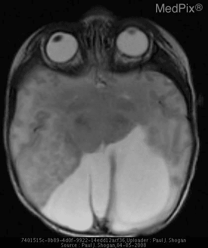 **Imaging Modality:** Axial T2-weighted MRI of the brain.