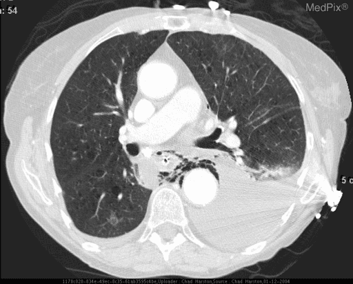 **Imaging Modality:** Axial Contrast-Enhanced Computed Tomography (CT) of the chest.