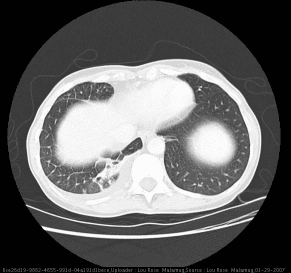 **Imaging Modality:** High-resolution computed tomography (HRCT) of the chest.