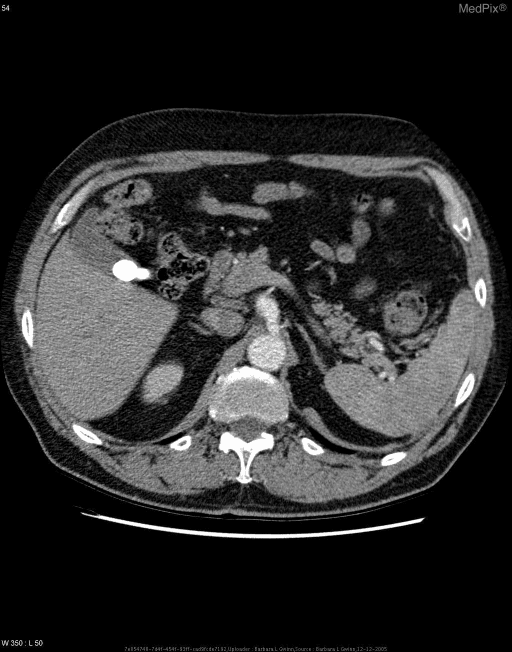 **Imaging Modality:** Axial computed tomography (CT) scan of the upper abdomen with intravenous contrast.