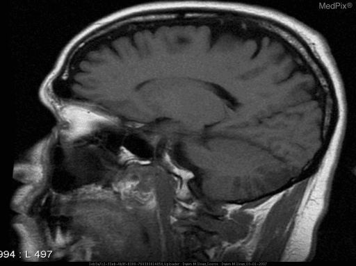 **Imaging Modality:** Magnetic Resonance Imaging (MRI)
**Anatomical Plane:** Sagittal view
**Anatomical Region:** Brain and upper cervical spine
**Key Observations:**
- **Parenchymal Findings:** The image demonstrates a T1-weighted sagittal section of the brain. There is a visible area of altered signal intensity within the posterior fossa, specifically involving the dorsolateral aspect of the medulla oblongata and the inferior portion of the cerebellum.
- **Vascular Distribution:** The location of the lesion is highly characteristic of an infarct within the territory of the posterior inferior cerebellar artery (PICA).
- **Associated Structures:** The sagittal view provides clear visualization of the brainstem (midbrain, pons, and medulla), the fourth ventricle, and the cerebellar hemispheres. The cortical sulci and gyri, corpus callosum, and pituitary gland appear within normal limits on this section.
**Clinical Significance:** This radiologic pattern is consistent with a lateral medullary infarct, the anatomical substrate for Wallenberg’s syndrome. Key diagnostic cues include the localized involvement of the medulla, which typically results from PICA or vertebral artery occlusion.
**Primary Keywords:** MRI, T1-weighted, sagittal, medulla oblongata, cerebellum, PICA infarct, lateral medullary syndrome, Wallenberg’s syndrome.
