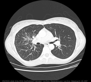 **Imaging Modality:** High-resolution Computed Tomography (HRCT) of the chest.