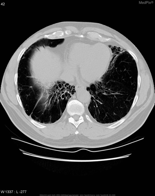 **Imaging Modality:** Axial Computed Tomography (CT) of the chest, lung window.
