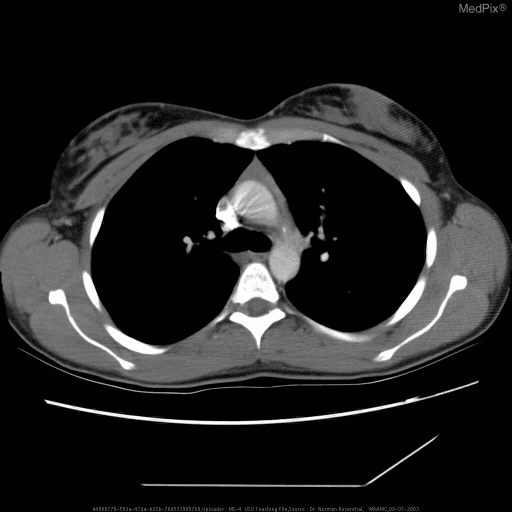 **Imaging Modality:** Computed Tomography (CT) scan of the chest.
**Anatomical Region:** Axial section of the superior mediastinum at the level of the aortic arch.
**Observed Pathology:** The image demonstrates a soft-tissue mass located in the anterior mediastinal compartment, specifically within the prevascular space. The morphology and location are consistent with thymic tissue, which in the context of myasthenia gravis, may represent thymic hyperplasia or a thymic neoplasm such as a thymoma.
**Characteristic Visual Features:**
* **Location:** Anterior to the ascending aorta and the superior vena cava, posterior to the sternum.
* **Density:** The lesion exhibits soft-tissue attenuation, appearing denser than the surrounding mediastinal fat.
* **Margins:** The mass appears relatively well-defined but lacks clear fatty cleavage planes from adjacent vascular structures, a common finding in thymic pathology.
* **Surrounding Structures:** The lungs appear clear and the bony structures of the thoracic cage are intact.
**Clinical Context:** Evaluation of the thymus is a critical diagnostic step for patients with myasthenia gravis to identify thymic abnormalities that may necessitate surgical intervention (thymectomy).
**Diagnostic Significance:** This imaging is essential for differentiating normal age-related thymic involution (fatty replacement) from pathological thymic persistence or enlargement.