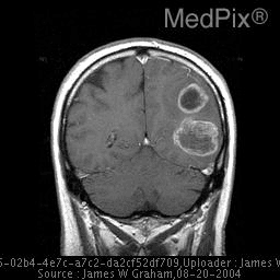 **Imaging Modality:** Coronal T1-weighted post-contrast Magnetic Resonance Imaging (MRI) of the brain.