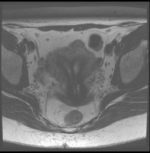 **Imaging Modality:** Magnetic Resonance Imaging (MRI)
**Anatomical Region:** Female pelvis, axial cross-section
**Observed Pathology:** Müllerian duct anomaly, specifically consistent with a **bicornuate uterus**.
**Characteristic Visual Features:**
The image displays a deep indentation of the external fundal contour, splitting the superior aspect of the uterus into two distinct cornua (horns). Centrally, a prominent muscular septum is visible, which separates the two diverging endometrial cavities. The pelvic musculature, iliac bones, and subcutaneous fat are visible in the periphery.
**Key Diagnostic Features:**
- **External Contour:** Deep fundal cleft (>1 cm), a primary feature used to differentiate a bicornuate uterus from a septate uterus.
- **Endometrial Cavities:** Two separate, widely divergent hyperintense endometrial signals.
- **Uterine Morphology:** "Heart-shaped" appearance of the uterine fundus on this axial slice.
**Clinical Significance:**
This radiological finding represents a fusion anomaly of the paramesonephric (Müllerian) ducts. It is essential for obstetric and gynecological indexing, as it is associated with increased risks of malpresentation, recurrent pregnancy loss, and preterm labor.